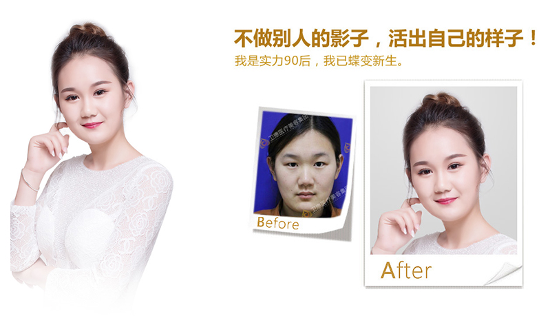 嘉义纳米脂肪移植